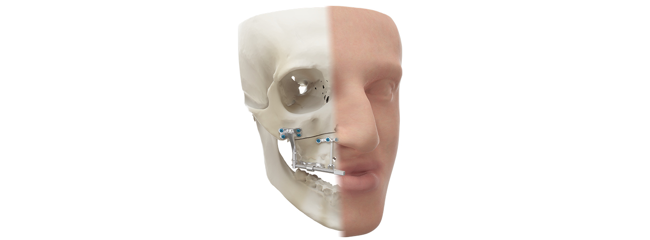 Malformations faciales : il est encore temps de faire un don pour produire un dispositif médical made in Besançon